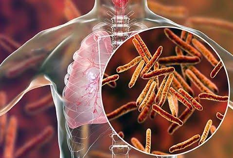 Ondo Logs 1,106 Cases Of Tuberculosis