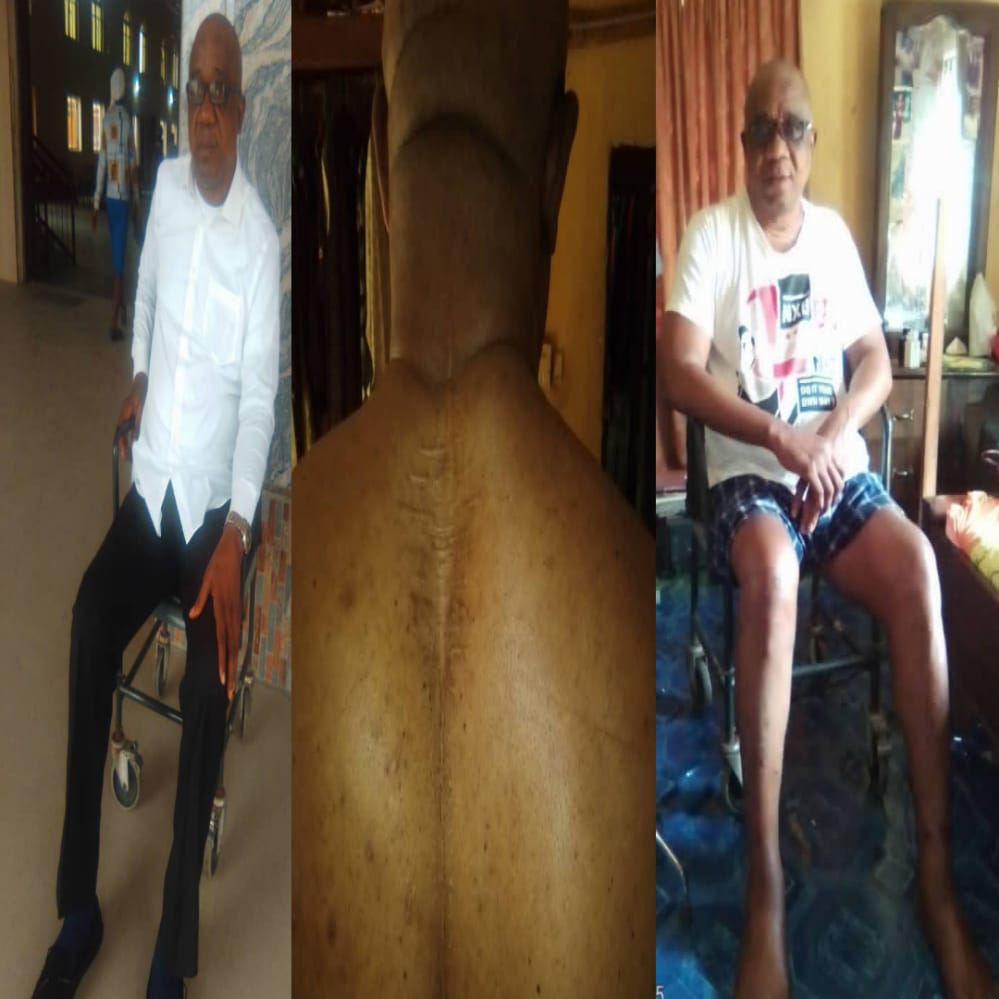 Help Nigerian Man, Declan Chinedu To Overcome Lumbar Spine Problem, Safe A Life
