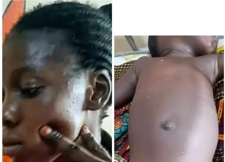Two-Year-Old Girl Battles For Life After Fulani Herdsmen Shoot In Private Part