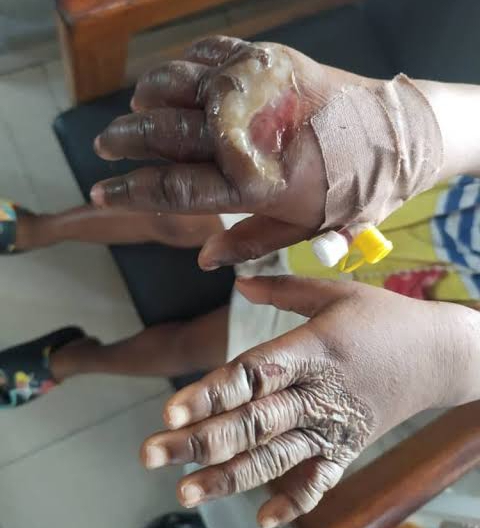 8 -year old kid lands in Hospital after Grandmother dips her hands inside Hot water in Ondo