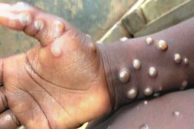 BREAKING: First Case Of Monkeypox Discovered In Osun