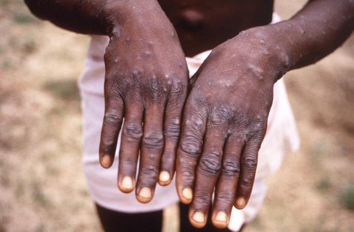 Breaking: Gombe confirms 3 cases of monkeypox