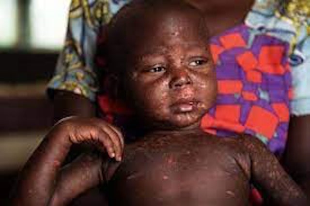 Dr. Usman: Disregard news of measles outbreak in Kogi 