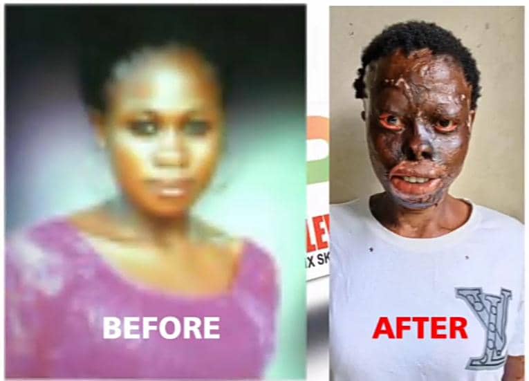 Nigerian Lady, Faith bathed with acid cries for help