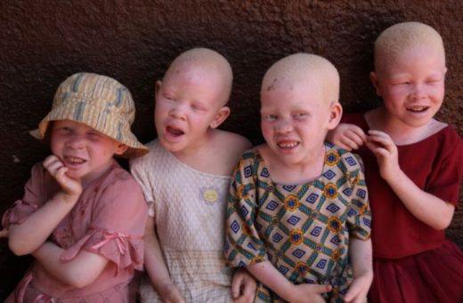 Revealed!Major health challenge of persons with Albinism 